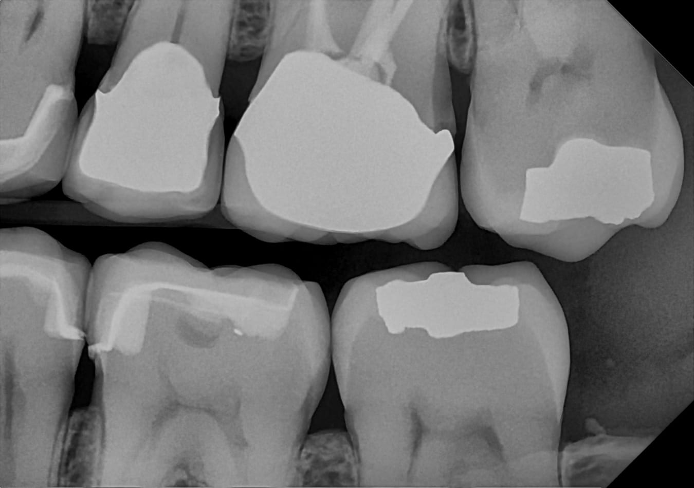 Oral Cancer